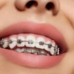 Remedios para el dolor de los brackets, InfoMistico.com