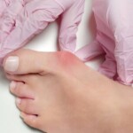 Biodescodificación Hallux Valgus, InfoMistico.com