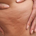 Cellulite Biodescodification, InfoMistico.com